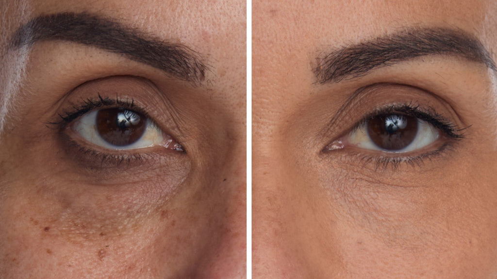HOW TO REMOVE DARK UNDEREYE CIRCLES: CAUSES, NATURAL FIXES & THE SECRET TO INSTANT BRIGHTENING